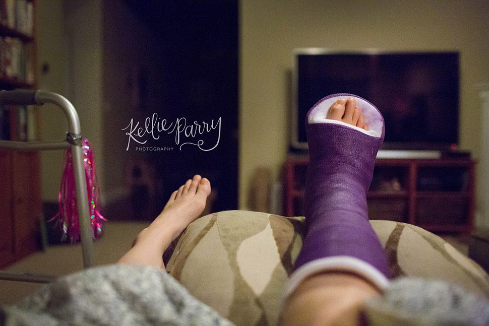 purple ankle cast